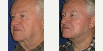 Roberto™ Device & Conductive Gel