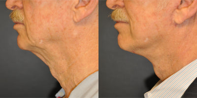 Roberto™ Device & Conductive Gel