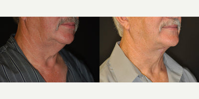 Roberto™ Device & Conductive Gel