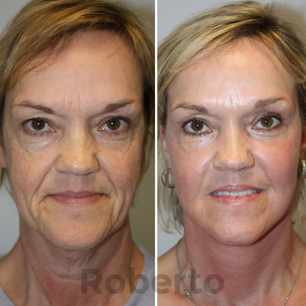 Roberto™ Anti-Aging Device 41 Wrinkles and Fine Lines